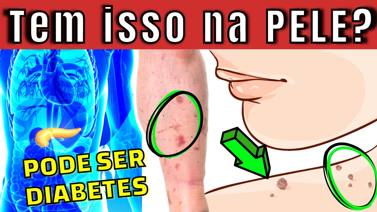 Os Primeiros Sinais da Pré-Diabetes que Você Deve Ficar Atento